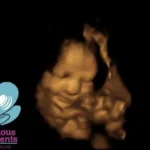 3D ultrasound